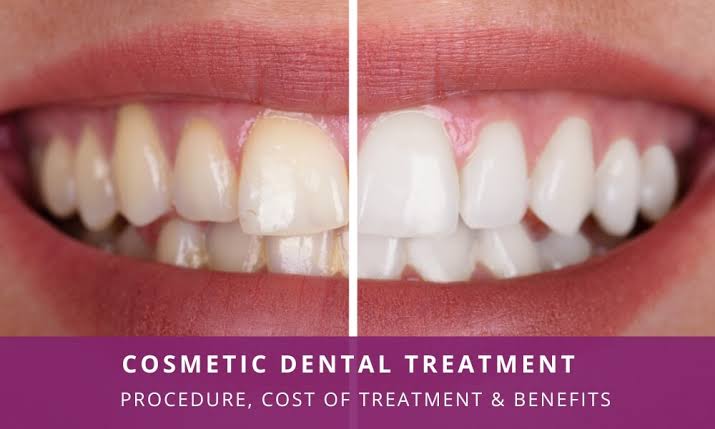 Teeth Whitening
