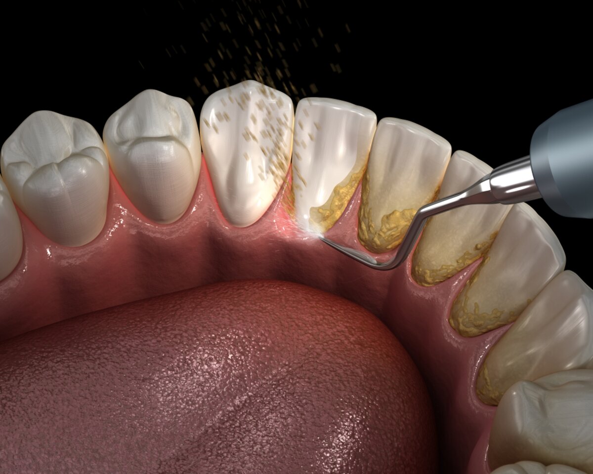 Teeth Cleaning (Scaling)