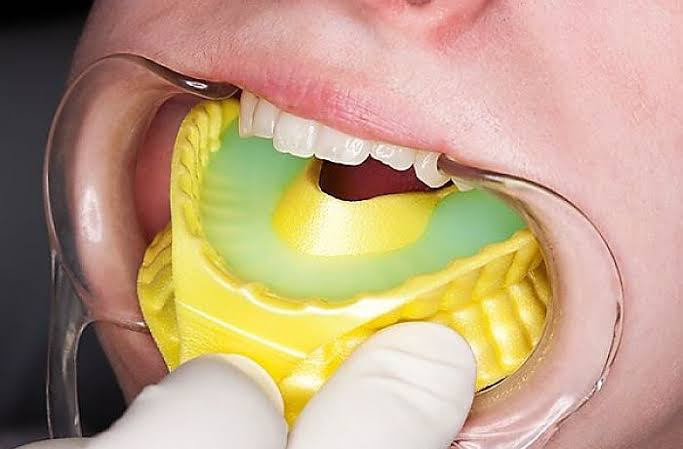 Fluoride Treatment