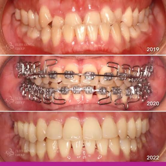 Braces (Metal)