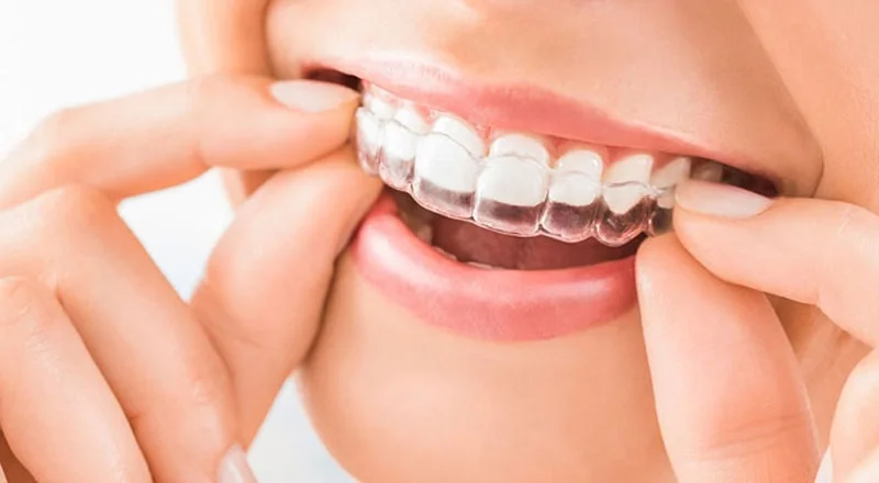 Braces (Invisalign)