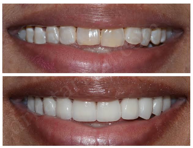 Dental Veneers